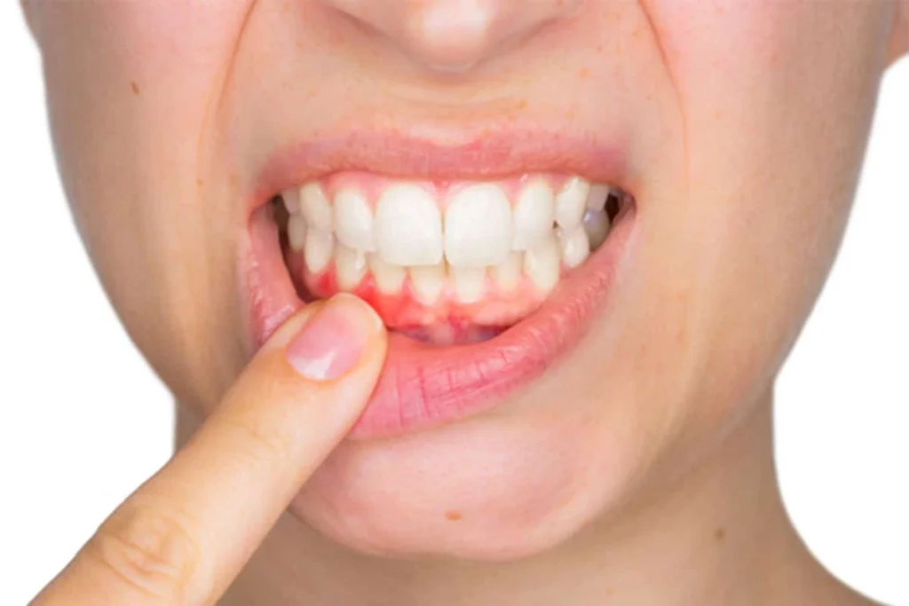 Swollen Gums: How Dental Services Can Help